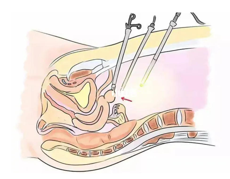 子(zǐ)宮肌瘤的(de)手術(shù)*