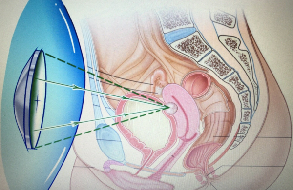 子(zǐ)宮肌瘤的(de)微(wēi)/無創手術(shù)*